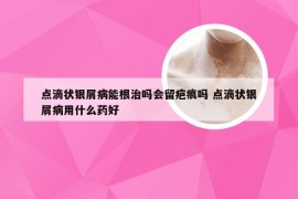 点滴状银屑病能根治吗会留疤痕吗 点滴状银屑病用什么药好