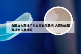 白醋加大蒜抹了对白斑有效果吗 大蒜加白醋可以治皮肤病吗