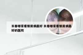 长春哪家看银屑病最好 长春哪家看银屑病最好的医院