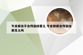 牛皮癣会不会传染给婴儿 牛皮肤癣会传染给新生儿吗