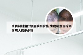 生物制剂治疗银屑病的价格 生物制剂治疗银屑病大概多少钱