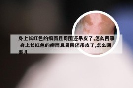 身上长红色的癣而且周围还吊皮了,怎么回事 身上长红色的癣而且周围还吊皮了,怎么回事儿