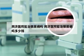 同济医院能治银屑病吗 同济医院能治银屑病吗多少钱