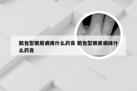 脓包型银屑病用什么药膏 脓包型银屑病抹什么药膏