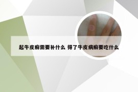 起牛皮癣需要补什么 得了牛皮病癣要吃什么