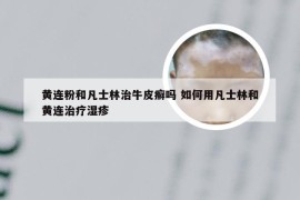 黄连粉和凡士林治牛皮癣吗 如何用凡士林和黄连治疗湿疹