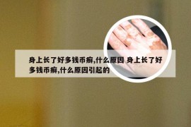 身上长了好多钱币癣,什么原因 身上长了好多钱币癣,什么原因引起的