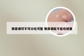 银屑病可不可以吃河蟹 银屑病能不能吃螃蟹