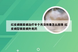 红皮病银屑病治疗半个月没效果怎么回事 红皮病型银屑病外用药