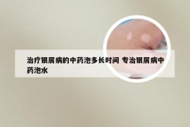 治疗银屑病的中药泡多长时间 专治银屑病中药泡水