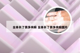 全身长了很多块癣 全身长了很多块癣图片