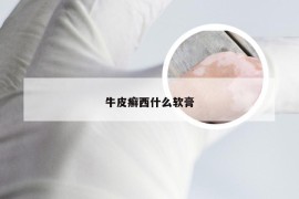 牛皮癣西什么软膏