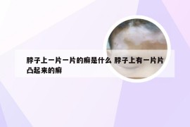 脖子上一片一片的癣是什么 脖子上有一片片凸起来的癣