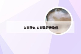 白斑传么 白斑是否传染啊