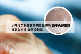 小孩得了头部银屑病能治好吗 孩子头部银屑病怎么治疗,如何控制呢