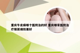 重庆牛皮癣哪个医院治的好 重庆哪家医院治疗银屑病效果好