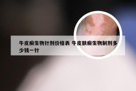 牛皮癣生物针剂价格表 牛皮肤癣生物制剂多少钱一针