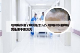 珊瑚癣净泡了脚变色怎么办 珊瑚藓净泡脚后变色用不用清洗