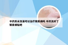 中药煎水洗澡可以治疗银屑病吗 中药洗好了银屑病贴吧