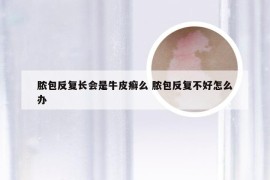 脓包反复长会是牛皮癣么 脓包反复不好怎么办