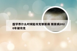 医学界什么时候能攻克银屑病 银屑病2020年被攻克