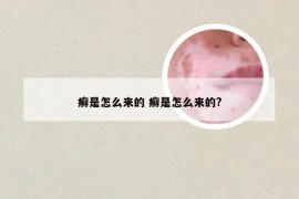 癣是怎么来的 癣是怎么来的?