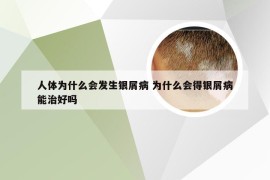 人体为什么会发生银屑病 为什么会得银屑病能治好吗