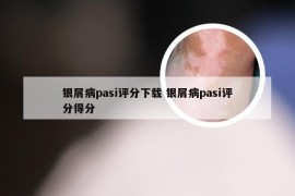 银屑病pasi评分下载 银屑病pasi评分得分