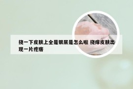 挠一下皮肤上全是银屑是怎么啦 挠痒皮肤出现一片疙瘩