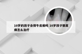 10岁的孩子会得牛皮癣吗 10岁孩子银屑病怎么治疗