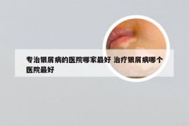 专治银屑病的医院哪家最好 治疗银屑病哪个医院最好