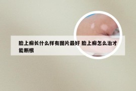 脸上癣长什么样有图片最好 脸上癣怎么治才能断根