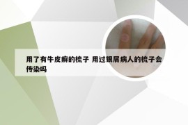 用了有牛皮癣的梳子 用过银屑病人的梳子会传染吗