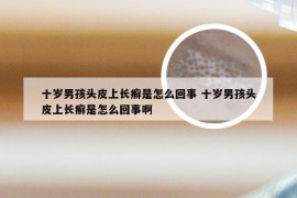 十岁男孩头皮上长癣是怎么回事 十岁男孩头皮上长癣是怎么回事啊