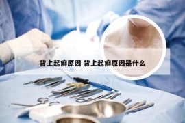 背上起癣原因 背上起癣原因是什么