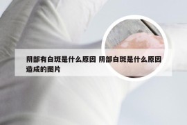 阴部有白斑是什么原因 阴部白斑是什么原因造成的图片