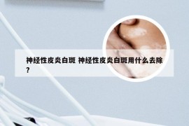 神经性皮炎白斑 神经性皮炎白斑用什么去除?