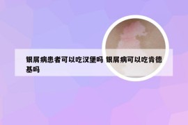 银屑病患者可以吃汉堡吗 银屑病可以吃肯德基吗