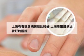 上海有看银屑病医院比较好 上海看银屑病比较好的医院