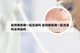 能和银屑病一起洗澡吗 能和银屑病一起洗澡吗会传染吗