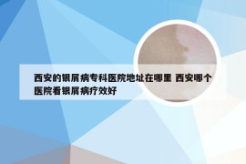 西安的银屑病专科医院地址在哪里 西安哪个医院看银屑病疗效好