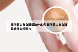 孩子脸上有白斑是缺什么吗 孩子脸上有白斑是缺什么吗图片