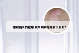 银屑病长的疙瘩 银屑病的疙瘩会下去么?