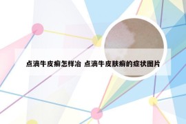 点滴牛皮癣怎样冶 点滴牛皮肤癣的症状图片