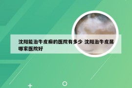 沈阳能治牛皮癣的医院有多少 沈阳治牛皮屑哪家医院好