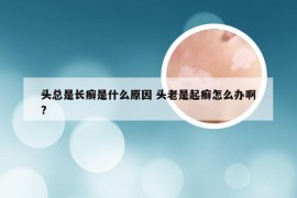 头总是长癣是什么原因 头老是起癣怎么办啊?