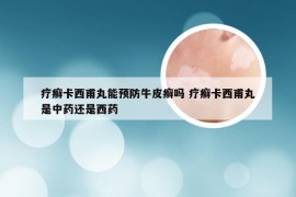 疗癣卡西甫丸能预防牛皮癣吗 疗癣卡西甫丸是中药还是西药