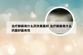 治疗脚癣用什么药效果最好 治疗脚癣用什么药最好最有效