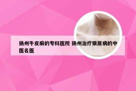 扬州牛皮癣的专科医院 扬州治疗银屑病的中医名医