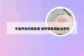 手指甲有坑银屑病 指甲银屑病能治愈吗